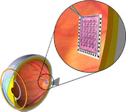 schéma de l'implant intraoculaire